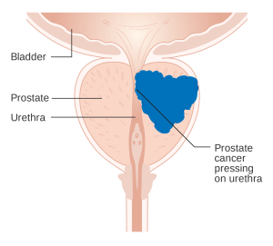 Diagram_showing_prostate_cancer_pressing_on_the_urethra_CRUK_182.svg